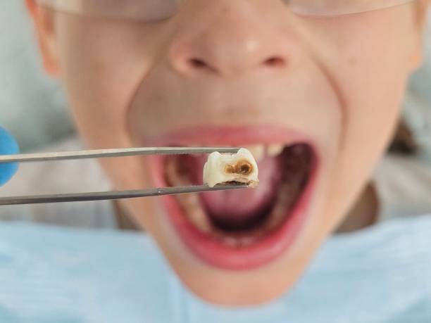 Best Emergency Treatment for Dental Infections or Abscesses in Sheridan, WY